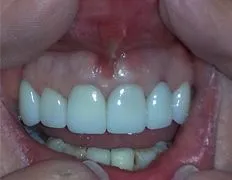 Teeth After