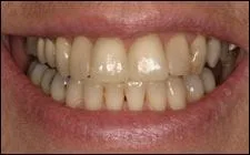 close up of man's smiling mouth after tooth gaps corrected with veneers Spokane, WA dentist