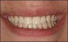smiling mouth after two teeth replaced by dental implants, Spokane, WA dentist