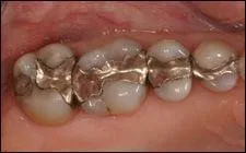 close up of row of teeth with gold fillings, general dentistry Spokane, WA