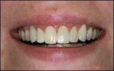 close up of person's mouth after getting veneers Spokane, WA cosmetic dentist