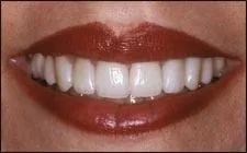 woman's mouth after professional teeth whitening Spokane, WA dentist