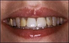 close up of woman's mouth with yellowed and discolored teeth, needs teeth whitening Spokane, WA dentist
