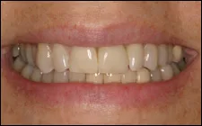 close up of smiling mouth showing all teeth after one front tooth replaced with dental implant Spokane dentist