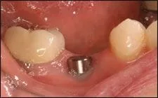 dental implant embedded in jaw between two natural teeth, dental implants Spokane, WA