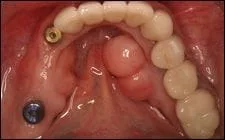 top view of lower arch of teeth showing multiple teeth missing, two embedded dental implants, Spokane, WA dentist