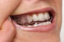 close up of mouth wearing oral appliance for sleep apnea, Skokie, IL sleep apnea treatment