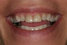 Female Veneer - Before