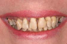 Female Smile Makeover - Before