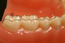 Invisalign 01a