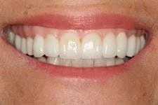 Veneers & Crowns - After