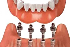 dentures