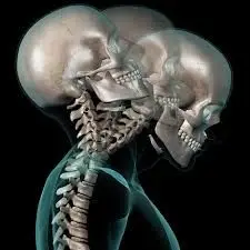 Image result for whiplash skull image