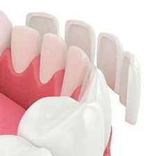 3D illustration of porcelain veneer pieces being placed over front of lower teeth, dentist Leesburg, VA veneers
