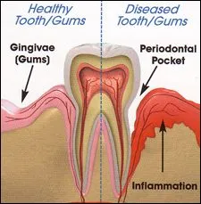 periodontal-disease-1