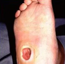 Diabetes foot