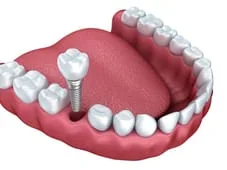 Dental Implants Pleasanton CA