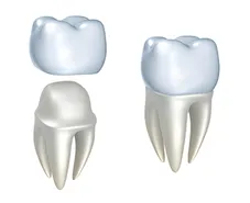 illustration of crown fitting over tooth, dental crowns Zebulon, NC dentist