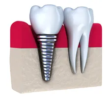 dental implant illustration Saddle Brook, NJ