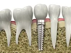 Implant1