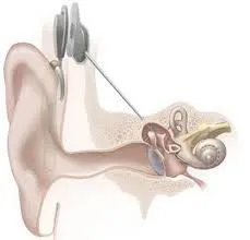 Cochlear Implants