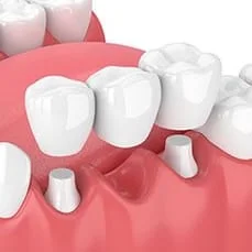 3D illustration of 3 unit dental bridge being placed over abutment teeth to replace missing lower tooth, dental bridge Littleton, CO cosmetic dentist