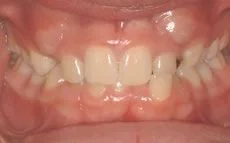 Teeth Crowding
