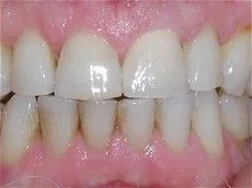 Single Tooth Crown 
