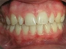 Single Tooth Veneer 