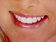 Lumineers_Veneers_Cosmetic_Dentistry.JPG