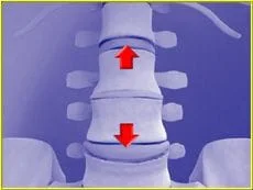Bulgin disc treatment NYC. Herniated disc decompression and spinal decompression for slipped discs in New York City