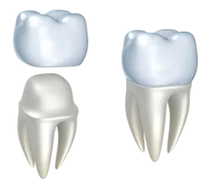 3D computer illustration of dental crown being placed over molar tooth, dental crowns Kanata, ON dentist