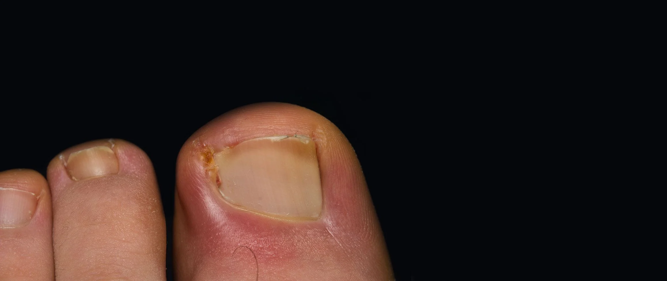 a picture of a painful in ingrown toenail
