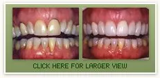 Crown and Veneers