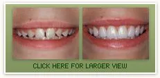 Porcelain Veneers