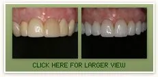 Porcelain Veneers