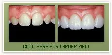 Porcelain Veneers