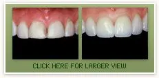 Porcelain Veneers