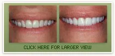 Porcelain Veneers