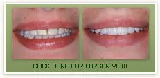 Porcelain Veneers