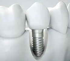 dentalimplants