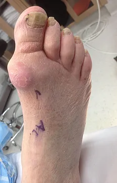 Stage 4 hallux rigidus with significant bone spur resection.