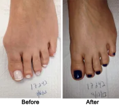 Cosmetic Foot Surgery Before and After 1