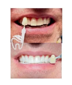 before and after whitening