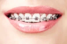 Metal Braces, Orthodontics Woodbridge