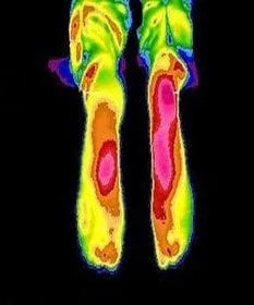 Baton Rouge Podiatrist | Baton Rouge Thermal Imaging Analysis | LA | Foot And Ankle Institute |
