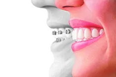 Novi Invisalign