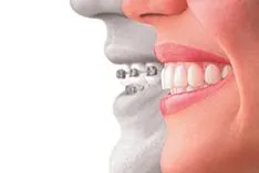 invisalign-profile