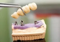 dental forceps holding dental bridge assembly near model of mouth. Shelby Twp, MI dental crowns and bridges
