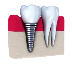 dental implants kalamazoo, MI